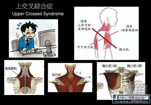 圆肩,驼背,头前引—上交叉综合症的肌动学基础及处理
